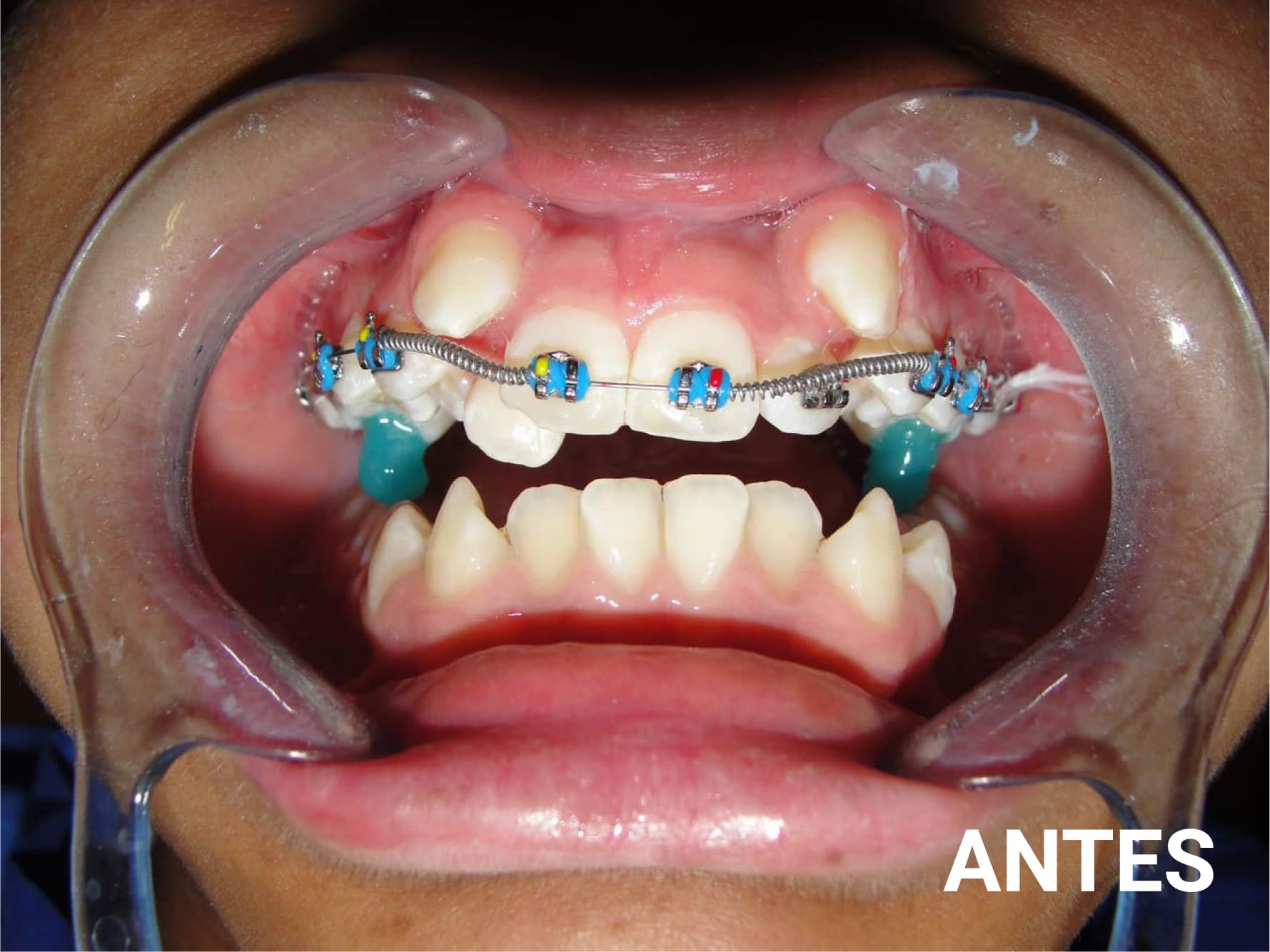 antes y despues ortodoncia-02