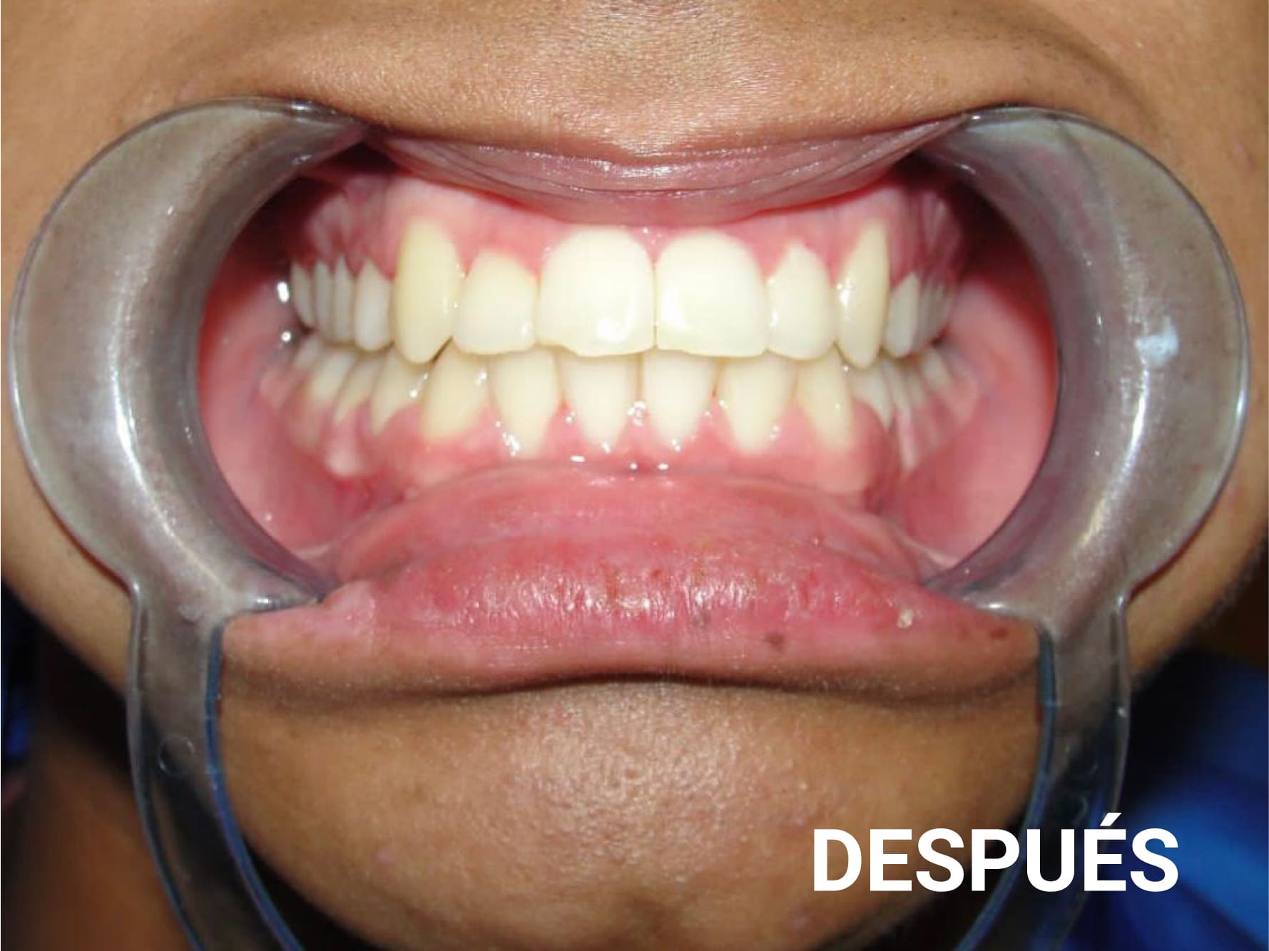 antes y despues ortodoncia-03