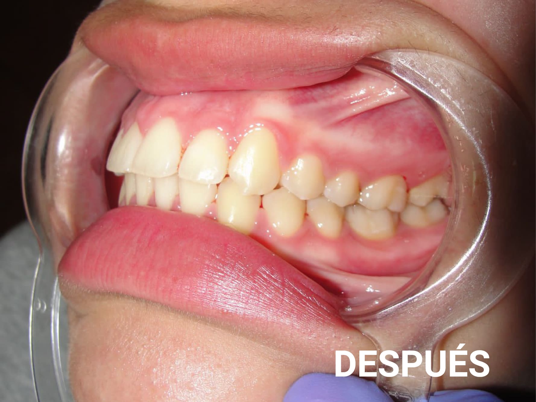 antes y despues ortodoncia-05